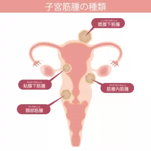 子宮筋腫と漢方薬のサムネイル